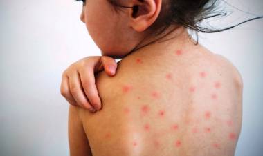 SE CONFIRMÓ UN CASO DE SARAMPIÓN Y HAY ALERTA EPIDEMIOLÓGICA