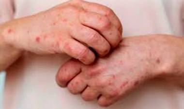 SE REGISTRARON 3 NUEVOS CASOS DE MPOX EN ARGENTINA Y YA SUMAN 11