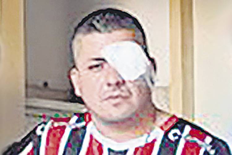 PERDIÓ LA VISIÓN DE UN OJO