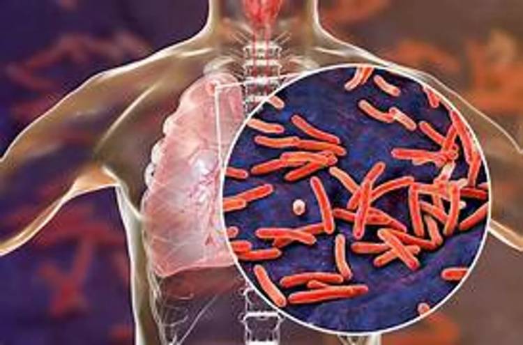 TUBERCULOSIS: ALERTA POR EL AUMENTO DE CASOS EN ARGENTINA